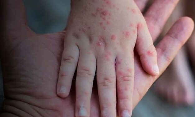 Planos devem cobrir teste da varíola dos macacos, diz ANS