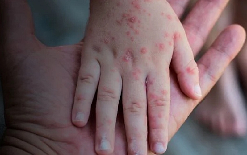 Planos devem cobrir teste da varíola dos macacos, diz ANS