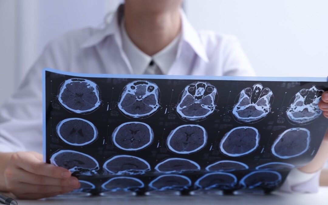 Esclerose Múltipla: entenda o que é, causas, sintomas e como diagnosticar